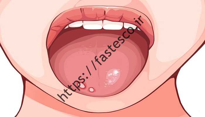 زخمهای دهان؛  علت، استراتژی و درمان توسط پزشک گوش و حلق و بینی
